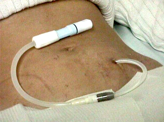 Peritoneal Dialysis Catheter